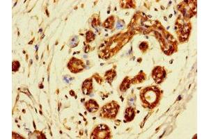 Immunohistochemistry of paraffin-embedded human breast cancer using ABIN7171277 at dilution of 1:100 (SDCBP2 抗体  (AA 11-207))