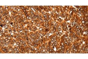 Immunohistochemistry of paraffin-embedded Human ovarian cancer using ALDOA Polyclonal Antibody at dilution of 1:30 (ALDOA 抗体)