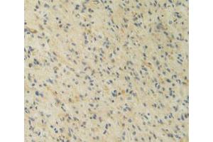 IHC-P analysis of Human Glioma Tissue, with DAB staining. (IL12A 抗体  (AA 23-219))