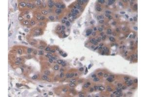 Detection of NT-ProBNP in Human Liver cancer Tissue using Polyclonal Antibody to N-Terminal Pro-Brain Natriuretic Peptide (NT-ProBNP)