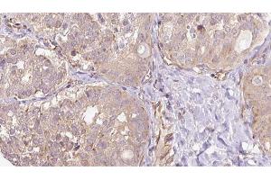 ABIN6273317 at 1/100 staining Human thyroid cancer tissue by IHC-P. (SGCG 抗体  (C-Term))