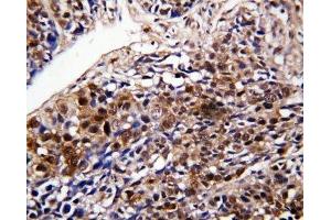 IHC-P: DDT antibody testing of human lung cancer tissue (DDT 抗体  (C-Term))