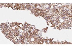 ABIN6272348 at 1/100 staining Human liver cancer tissue by IHC-P. (CDC42BPB 抗体  (C-Term))