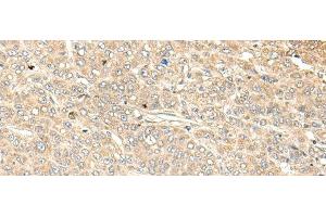 Immunohistochemistry of paraffin-embedded Human liver cancer tissue using WDFY4 Polyclonal Antibody at dilution of 1:50(x200) (WDFY4 抗体)