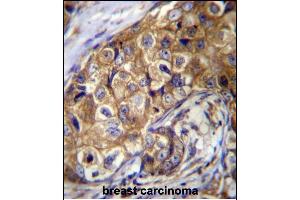 CTAGE5 Antibody (C-term) (ABIN656676 and ABIN2845915) immunohistochemistry analysis in formalin fixed and paraffin embedded human breast carcinoma followed by peroxidase conjugation of the secondary antibody and DAB staining. (MIA2 抗体  (C-Term))