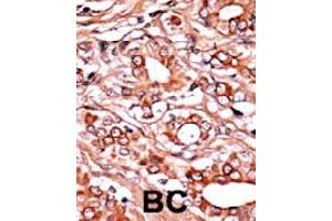 Formalin-fixed and paraffin-embedded human cancer tissue reacted with ABL1 (phospho Y134) polyclonal antibody  which was peroxidase-conjugated to the secondary antibody followed by AEC staining. (ABL1 抗体  (pTyr134))