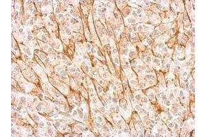 IHC-P Image NMDAR2A antibody detects GRIN2A protein at membrane on U87 xenograft by immunohistochemical analysis. (NMDAR2A 抗体  (N-Term))