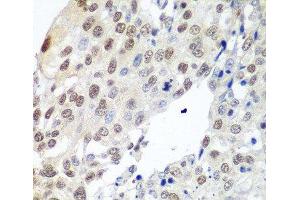 Immunohistochemistry of paraffin-embedded Human lung cancer using PTTG1 Polyclonal Antibody at dilution of 1:100 (40x lens). (PTTG1 抗体)