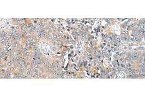 Immunohistochemistry of paraffin-embedded Human prost at e cancer tissue using COMMD6 Polyclonal Antibody at dilution of 1:45(x200) (COMMD6 抗体)