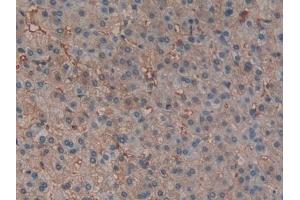 Detection of HBb in Human Liver cancer Tissue using Polyclonal Antibody to Hemoglobin Beta (HBb) (Hemoglobin Subunit beta 抗体  (AA 1-147))