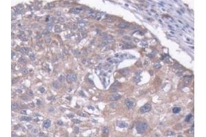 Detection of MAP1B in Human Liver cancer Tissue using Polyclonal Antibody to Microtubule Associated Protein 1B (MAP1B) (MAP1B 抗体  (AA 2207-2468))