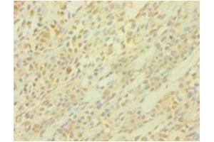 Immunohistochemistry of paraffin-embedded human breast cancer using ABIN7164283 at dilution of 1:100 (PICK1 抗体  (AA 1-200))
