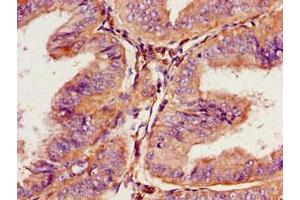 Immunohistochemistry of paraffin-embedded human endometrial cancer using ABIN7164713 at dilution of 1:100 (Prokineticin Receptor 2 抗体  (AA 1-45))