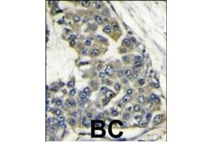 Formalin-fixed and paraffin-embedded human breast carcinoma reacted with EIF4B antibody (Center) (ABIN388669 and ABIN2837872) , which was peroxidase-conjugated to the secondary antibody, followed by DAB staining. (EIF4B 抗体  (AA 353-382))