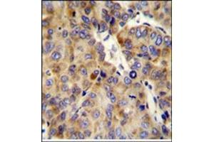 Formalin fixed and paraffin embedded human hepatocarcinoma stained with COL18A1 Antibody (Center) Cat. (COL18A1 抗体  (Chain alpha 1, Middle Region))