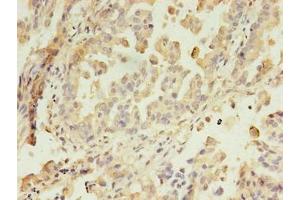 Immunohistochemistry of paraffin-embedded human lung cancer using ABIN7144550 at dilution of 1:100 (GIT2 抗体  (AA 1-603))