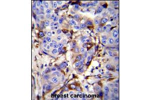 GCDFP-15 Antibody (C-term) (ABIN655074 and ABIN2844706) immunohistochemistry analysis in formalin fixed and paraffin embedded human breast carcinoma followed by peroxidase conjugation of the secondary antibody and DAB staining. (PIP 抗体  (C-Term))