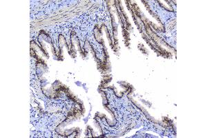 IHC analysis of splicing factor 1 using anti-splicing factor 1 antibody .