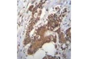 Immunohistochemistry analysis in formalin fixed and paraffin embedded human colon carcinoma reacted with PCYT1A Antibody (N-term) followed by peroxidase conjugation of the secondary antibody and DAB staining. (PCYT1A 抗体  (N-Term))