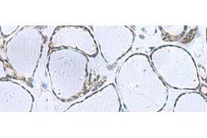 Immunohistochemistry of paraffin-embedded Human thyroid cancer tissue using POMC Polyclonal Antibody at dilution of 1:35(x200) (POMC 抗体)
