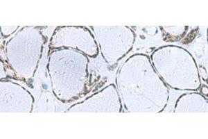 Immunohistochemistry of paraffin-embedded Human thyroid cancer tissue using POMC Polyclonal Antibody at dilution of 1:35(x200)