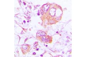 Immunohistochemical analysis of Cathepsin H staining in human lung cancer formalin fixed paraffin embedded tissue section.