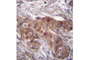 Immunohistochemistry analysis in formalin fixed and paraffin embedded human breast carcinoma using LPAR6 Antibody (Center) followed which was peroxidase conjugated to the secondary antibody and followed by DAB staining. (LPAR6 抗体  (Middle Region))