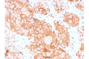 Formalin-fixed, paraffin-embedded human testicular carcinoma stained with Prolactin Receptor Recombinant Rabbit Monoclonal (PRLR3785R). (Recombinant Prolactin Receptor 抗体)