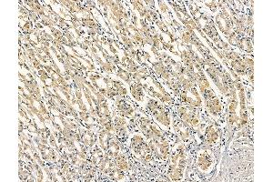 ABIN6263325 and ABIN6279013 at 1/100 staining human colorectal cancer and adjacent non-tumor tissue by IHC-P. (MOGAT3 抗体  (C-Term))