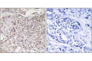 Immunohistochemistry analysis of paraffin-embedded human breast carcinoma, using GPRIN3 Antibody. (GPRIN3 抗体  (AA 131-180))