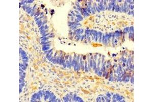 Immunohistochemistry of paraffin-embedded human ovarian cancer using ABIN7148136 at dilution of 1:100 (CCDC66 抗体  (AA 87-286))