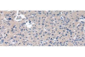 Immunohistochemistry of paraffin-embedded Human liver cancer using RAB2A Polyclonal Antibody at dilution of 1/40 (RAB2A 抗体)