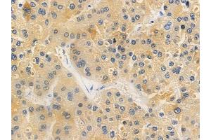 ABIN6259412 and ABIN6276184 at 1/100 staining human hepatocellular carcinoma by IHC-P.