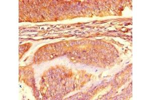 Immunohistochemistry of paraffin-embedded human endometrial cancer using ABIN7160847 at dilution of 1:100 (NAD-ME 抗体  (AA 296-424))