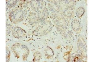Immunohistochemistry of paraffin-embedded human breast cancer using ABIN7173225 at dilution of 1:100 (TMEM45A 抗体  (AA 171-217))