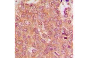 Immunohistochemical analysis of MID1 staining in human breast cancer formalin fixed paraffin embedded tissue section. (MID1 抗体  (N-Term))