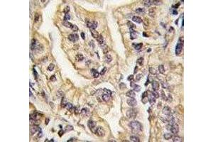 IHC analysis of FFPE human lung carcinoma tissue stained with CSF1R antibody