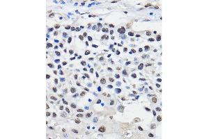 Immunohistochemistry of paraffin-embedded Human esophageal cancer using hnRNP U Rabbit pAb (ABIN1680323, ABIN3018279, ABIN3018280 and ABIN6220424) at dilution of 1:50 (40x lens).