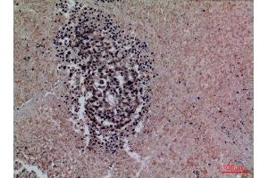 Immunohistochemistry (IHC) analysis of paraffin-embedded Human Lung Cancer, antibody was diluted at 1:100. (Surfactant Protein A1 抗体  (Internal Region))