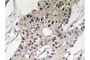 Immunohistochemical analysis of paraffin-embedded human breast cancer tissue using DEFA1 polyclonal antibody . (alpha Defensin 1 抗体)