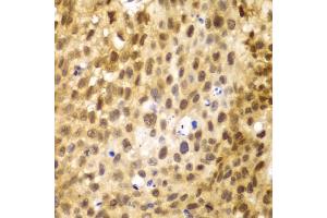 Immunohistochemistry of paraffin-embedded human lung cancer using IRF3 antibody (ABIN5998002) at dilution of 1/100 (40x lens). (IRF3 抗体)