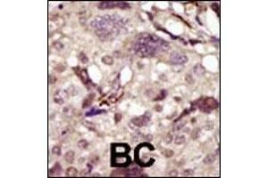 Formalin-fixed and paraffin-embedded human cancer tissue reacted with the primary antibody, which was peroxidase-conjugated to the secondary antibody, followed by DAB staining. (BTK 抗体  (AA 209-239))