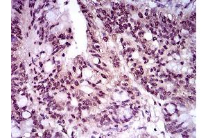 Immunohistochemical analysis of paraffin-embedded rectum cancer tissues using T mouse mAb with DAB staining. (T Antigen (AA 257-309) 抗体)