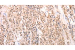 Immunohistochemistry of paraffin-embedded Human liver cancer tissue using ACIN1 Polyclonal Antibody at dilution 1:80 (ACIN1 抗体)