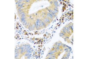 Immunohistochemistry of paraffin-embedded human colon carcinoma using MANF antibody. (MANF 抗体)