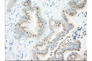 Immunohistochemical staining of paraffin-embedded Adenocarcinoma of Human colon tissue using anti-IFT57 mouse monoclonal antibody. (IFT57 抗体)