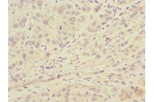 Immunohistochemistry of paraffin-embedded human liver cancer using ABIN7157914 at dilution of 1:100 (LSS 抗体  (AA 1-300))
