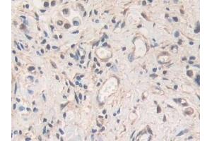 Detection of MMP19 in Human Stomach cancer Tissue using Polyclonal Antibody to Matrix Metalloproteinase 19 (MMP19)