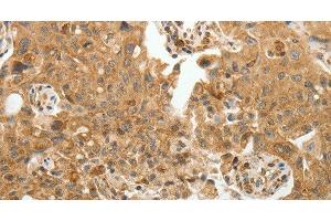 Immunohistochemistry of paraffin-embedded Human lung cancer tissue using TFPI2 Polyclonal Antibody at dilution 1:30 (TFPI2 抗体)