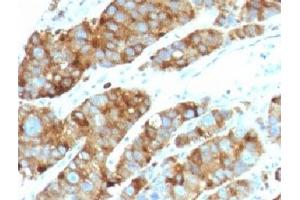 Formalin-fixed, paraffin-embedded human prostate carcinoma stained with LAMP3 antibody (LAMP3/968) (LAMP3 抗体)
